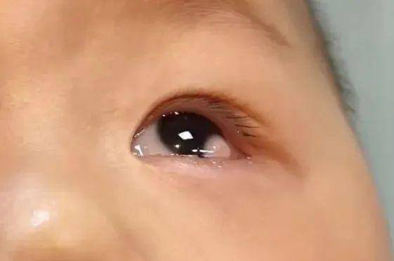 爱眼日-关注普遍的眼健康|山东省眼科医院开展爱眼日系列活动_角膜