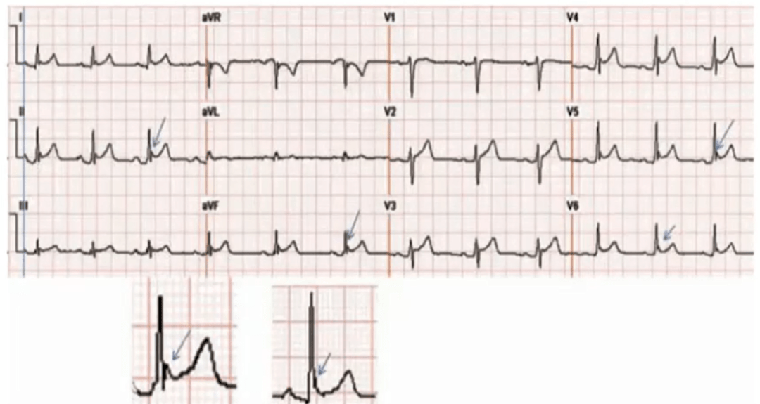 心电图st段下斜型抬高图片