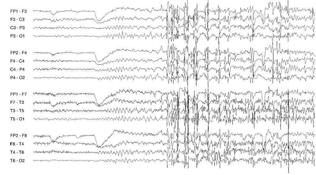 儿童良性癫脑电图图片