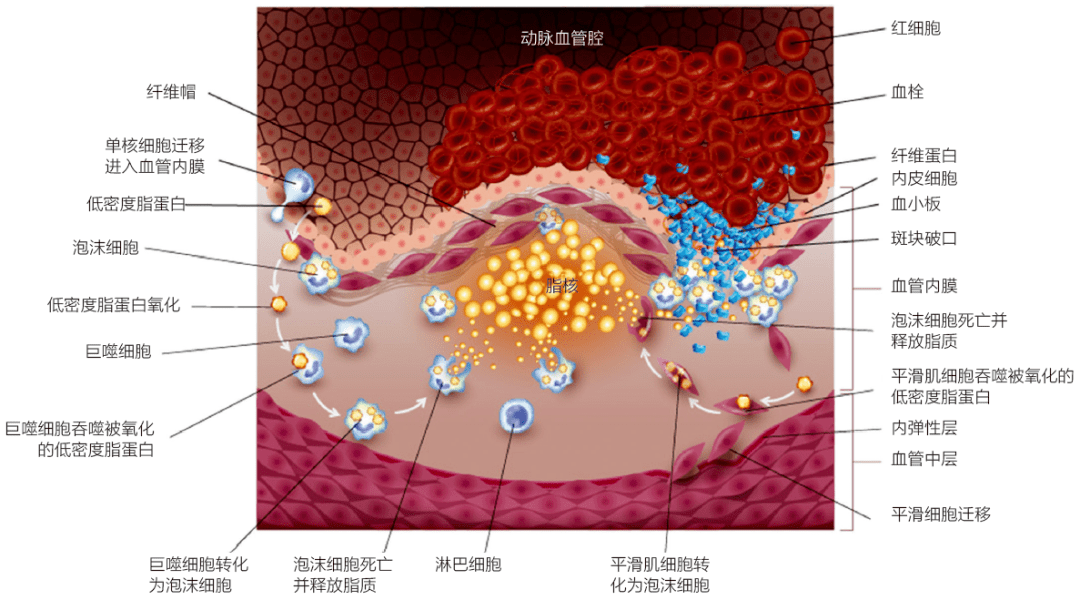 动脉硬化or动脉粥样硬化