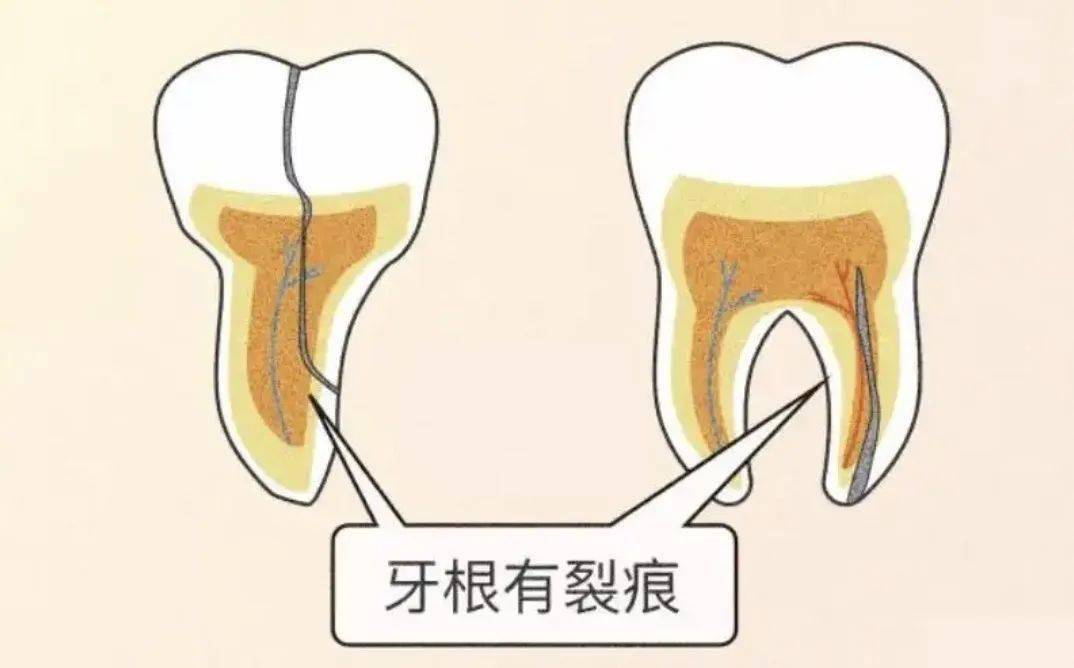 有一种隐形牙痛叫——牙齿隐裂!