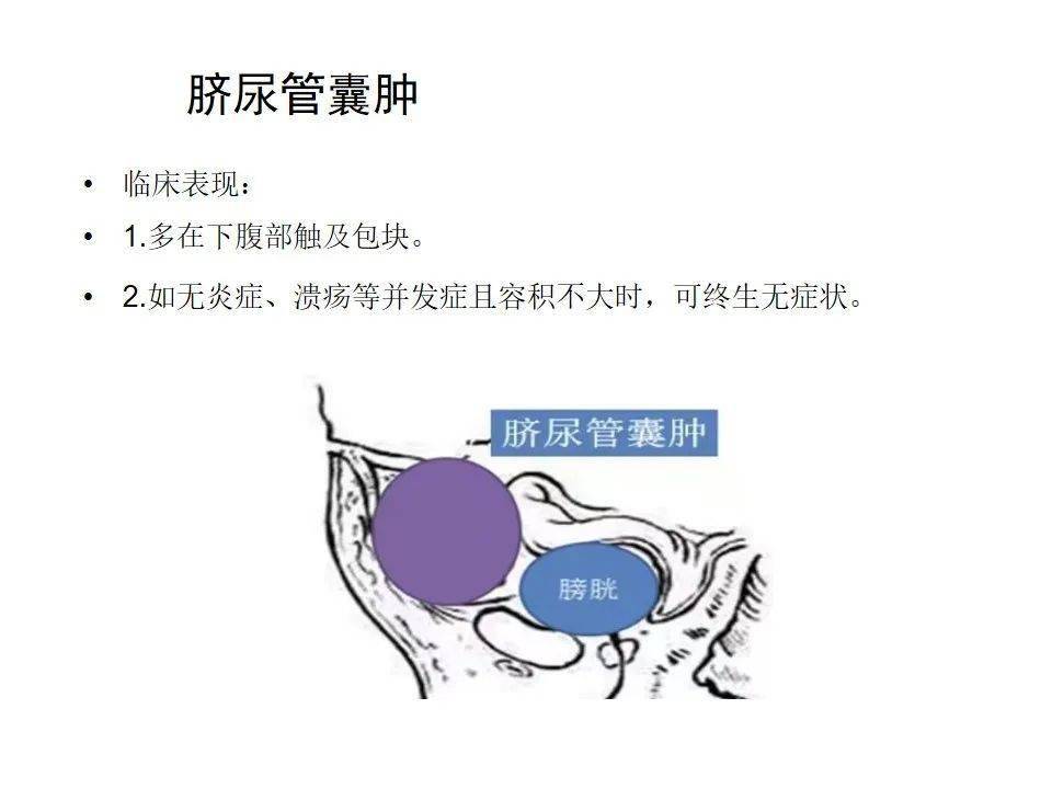 脐尿管感染图片