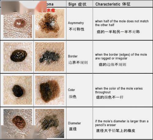 目前,色素痣分3型:交界痣,皮内痣,混合痣