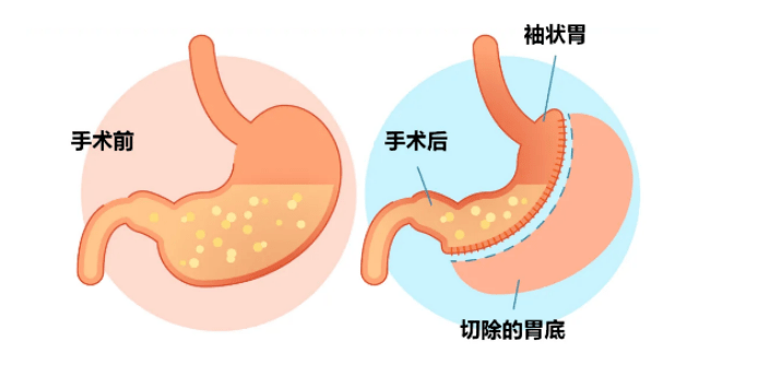 胃大部分切除手术图片