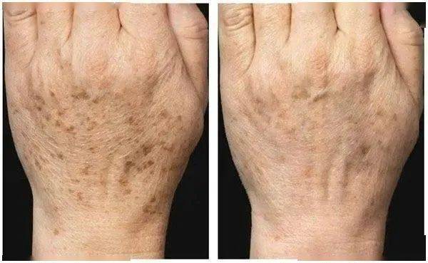 为什么有些人满脸长满"老年斑",有的人脸上却干干净净呢?