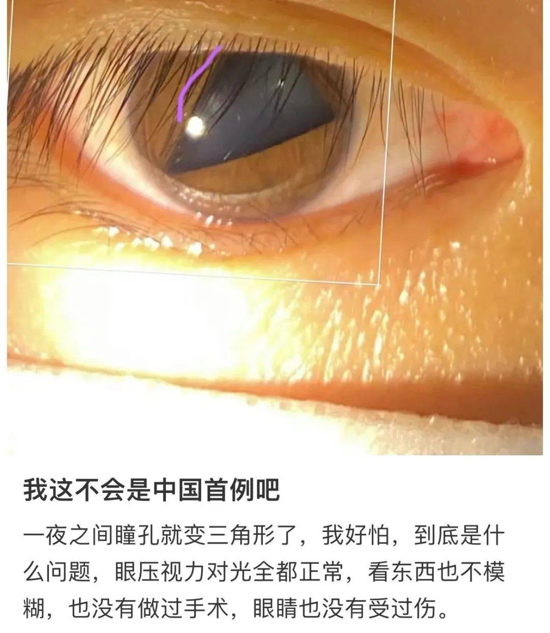 医院确诊为……_眼睛_虹膜_角膜