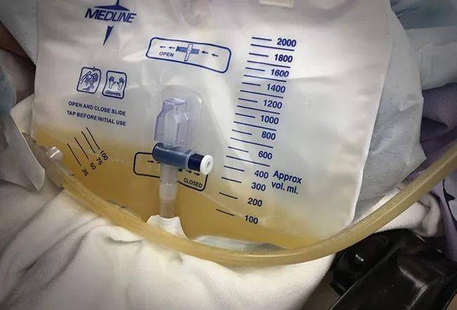 带管余生|长期留置导尿异常问题的处理_导尿管_患者_进行