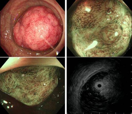 肠道息肉多发图片