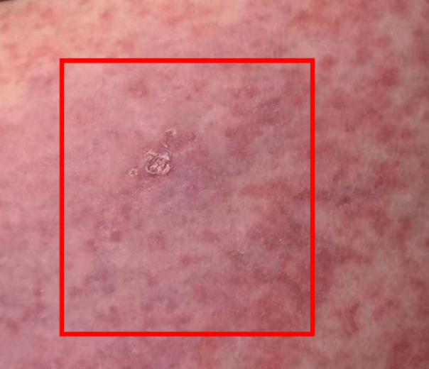 女子脸烂成"火龙果",全身布满红斑,竟因家里有它_恙虫_仓鼠_医生