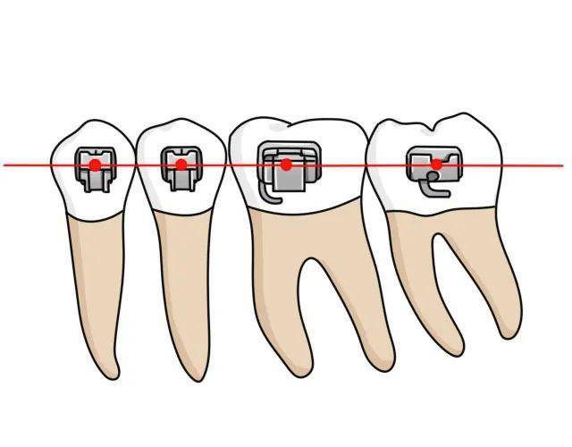 托槽槽沟中心点和临床牙冠中心点重合
