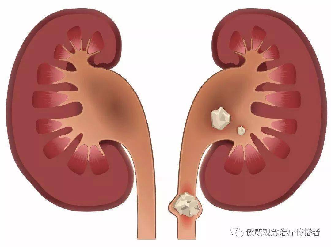 肾结晶是怎么回事 来自搜狐网
