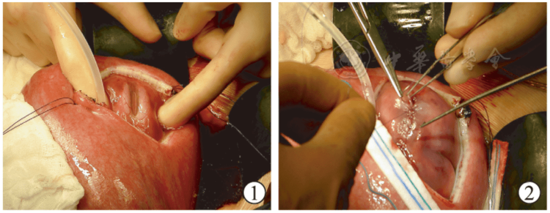 的患兒被確診為蓋倫靜脈畸形(vein of galen aneurysm malformation