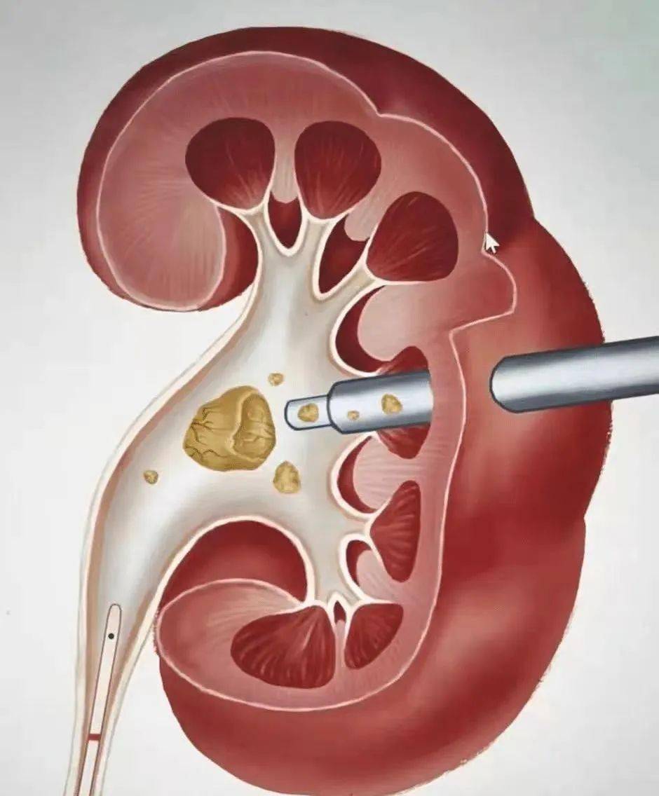 经皮肾镜,碎石另辟蹊径