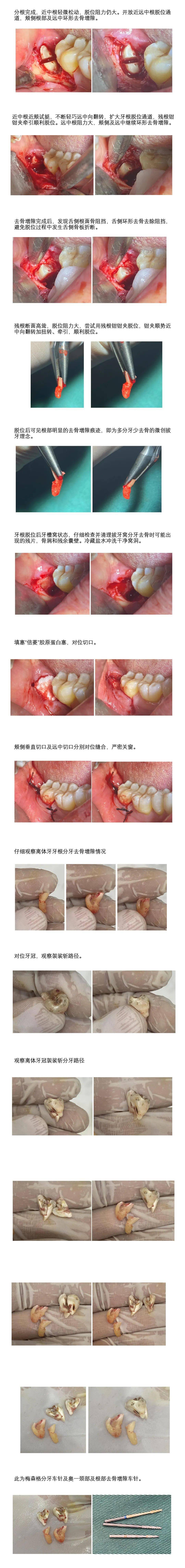 【优秀病例分享】下颌近中中位智齿拔牙病例