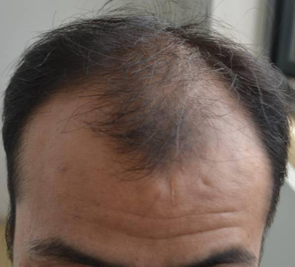 六七十岁男人,比白发更可怕的是头发稀疏,显老10岁不止
