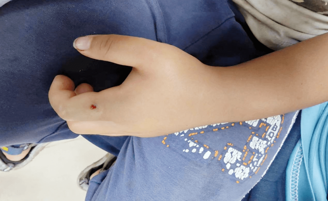 "竹叶青"6月27日晚上九时许,4岁的小宝(化名),因"被蛇咬伤肿痛2小时"