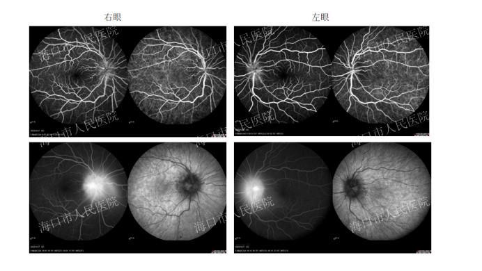眼底照片:双眼视盘水肿,黄斑区褶皱眼部专科检查(图1-5):双眼球结膜