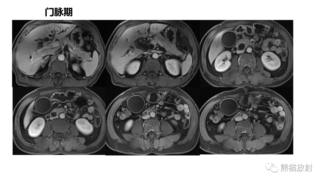 胰胆管合流异常并十二指肠乳头腺癌,胆总管下段腺癌你想到了吗?