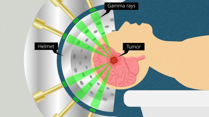 伽瑪刀翻譯自英文gamma knife,雖然名字中有個刀,但是並不是真正的