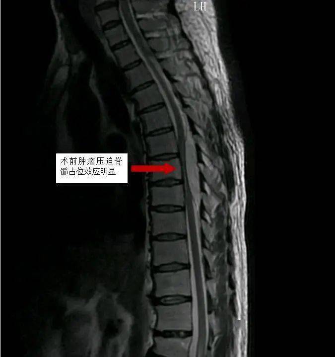 入院后,胸椎增强磁共振示胸6-8椎体层面椎管后缘梭形异常信号-考虑髓