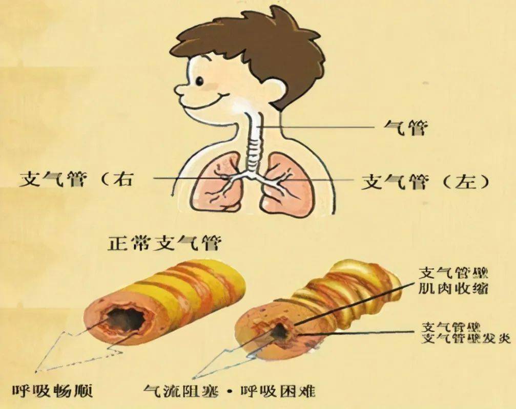 【妇儿科普】如何预防支气管肺炎