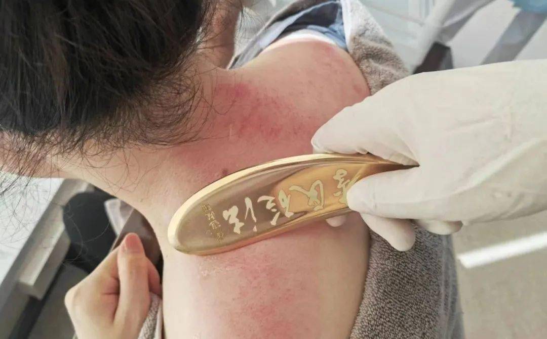 养生有道 | 虎符铜砭刮痧_治疗_手法_疗法