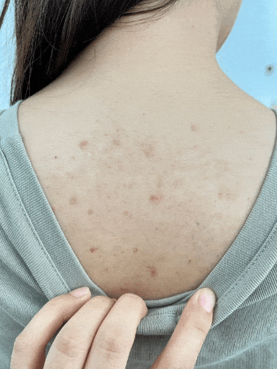 这瓶祛痘,除螨沐浴露真不是智商税!_皮肤_痘痘_后背