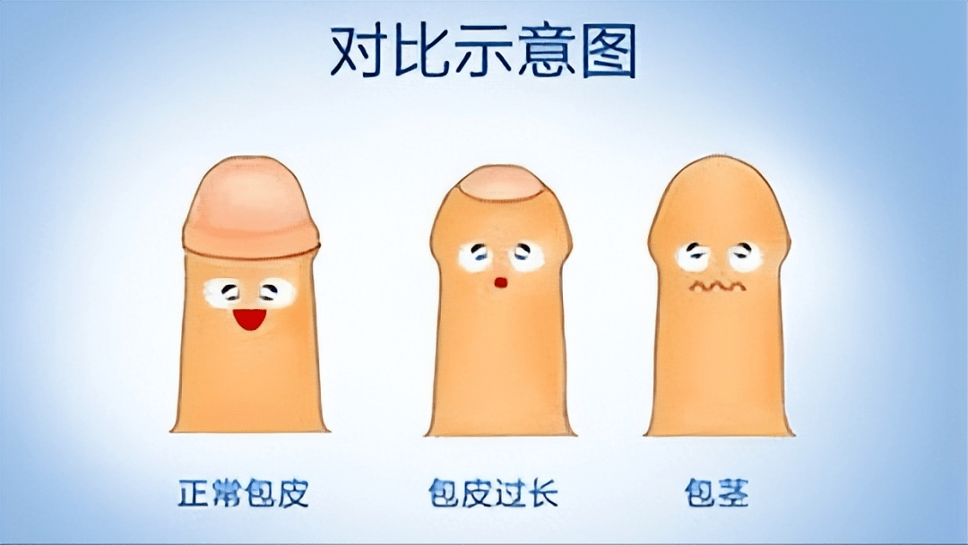 割“包皮”究竟好不好？不论如何，你都要搞懂这三个问题！