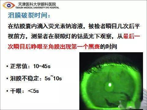 泪膜破裂时间图片