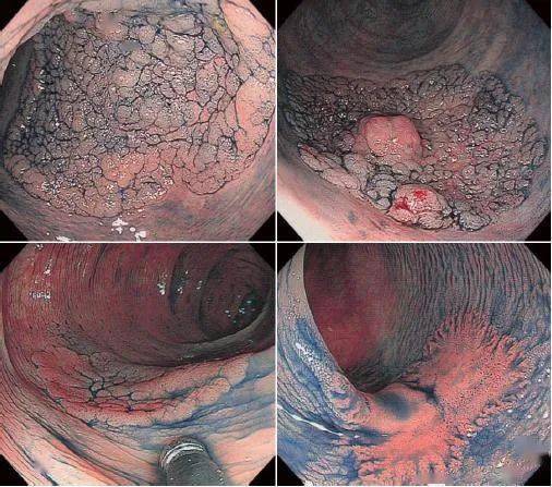 医师节特辑 | 余杭三院成功开展内镜下直肠巨大侧向发育型肿瘤esd手术