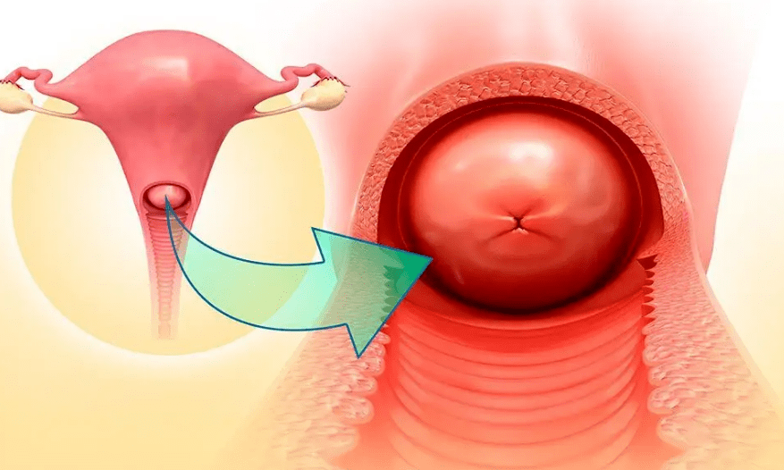 【科普知识】宫颈糜烂真的是炎症吗?_治疗_诊断_上皮