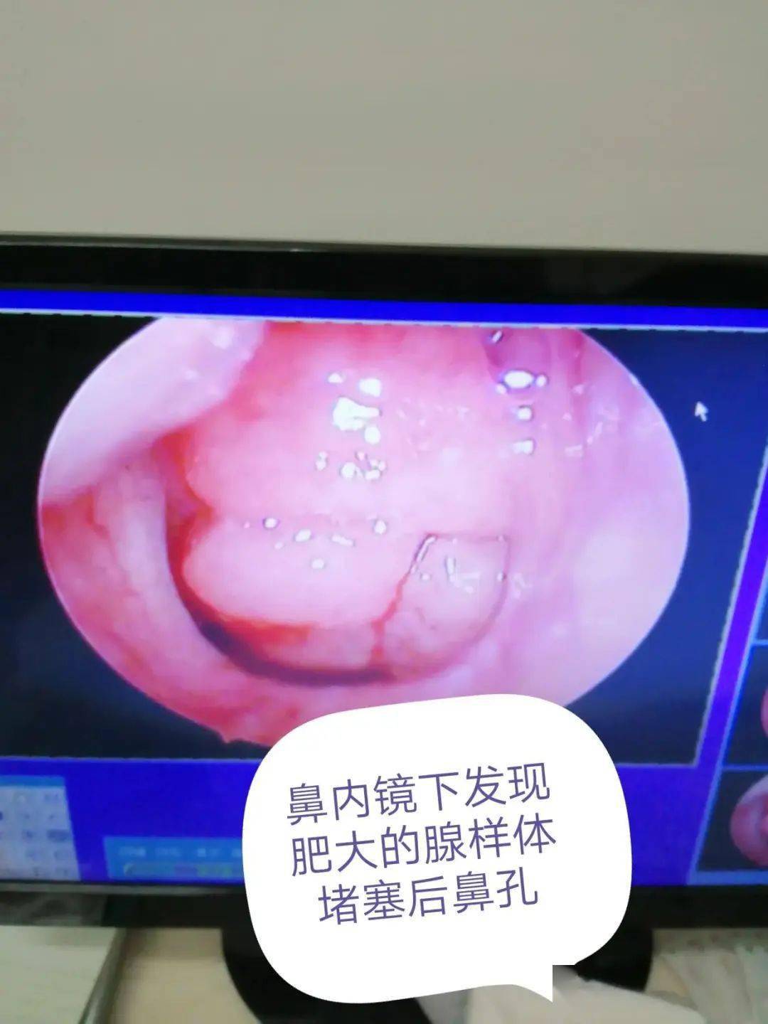 腺样体肥大的危害,您知道吗?