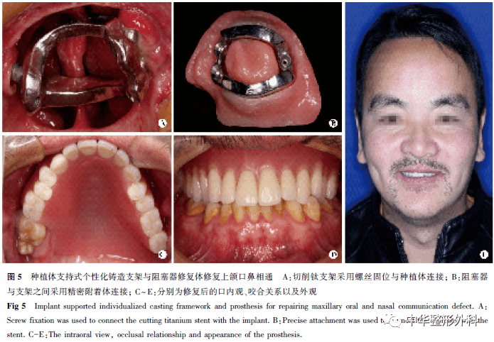 动态导航技术在穿颧种植手术的应用_颧骨_患者_进行