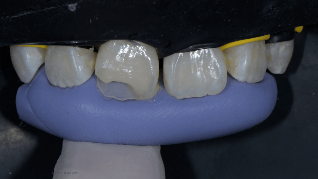 全国决赛12强病例展示 陆炳河 11牙体缺损树脂充填