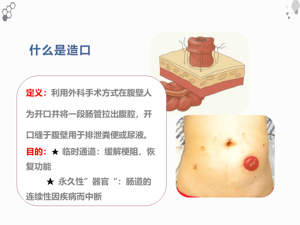 【ppt】一例结肠癌术后肠造口缺血坏死护理查房