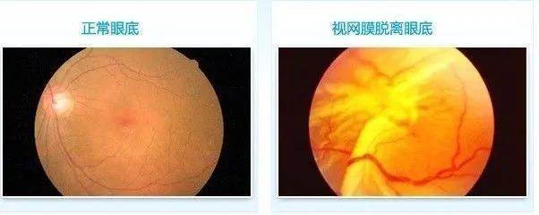 近视手术也解决不了的高度近视并发症!_问题_视网膜_眼球