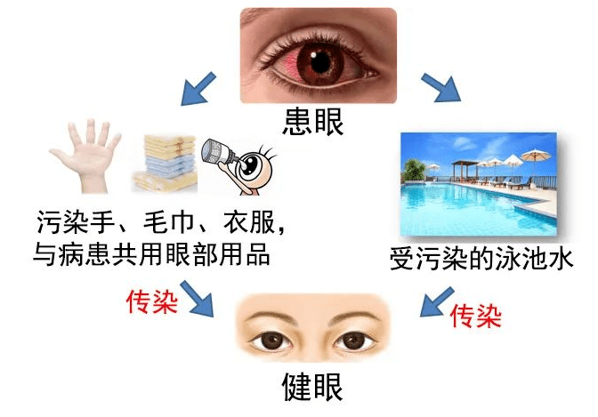 近期"红眼病"高发!惠来疾控中心发布提醒!