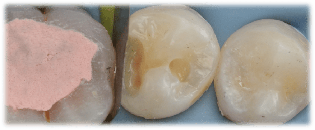 全国决赛12强病例展示 王林强 二类洞直接修复一例:右下五树脂充填