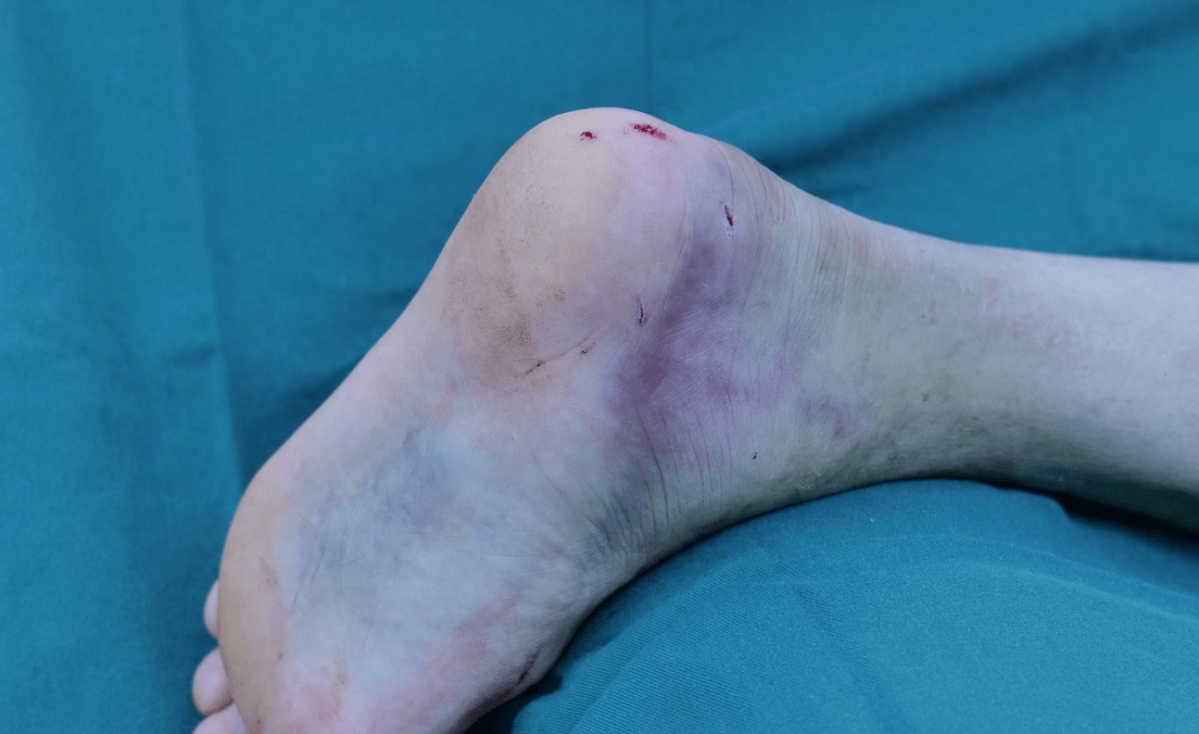 并逐步出现肿胀,皮肤青紫,后逐渐加重,来到我院就诊,诊断为左跟骨骨折