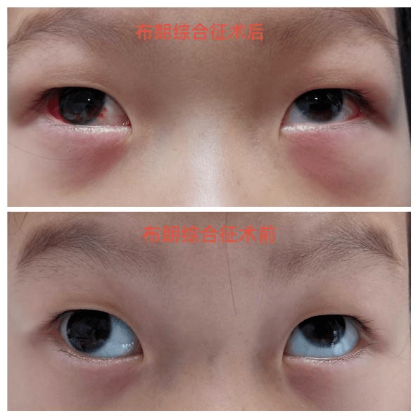 怀疑孩子有『斜视』!四大方法教您自查!_眼球_患儿_左眼