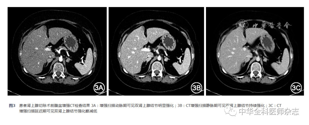 【经验交流】carney综合征1例