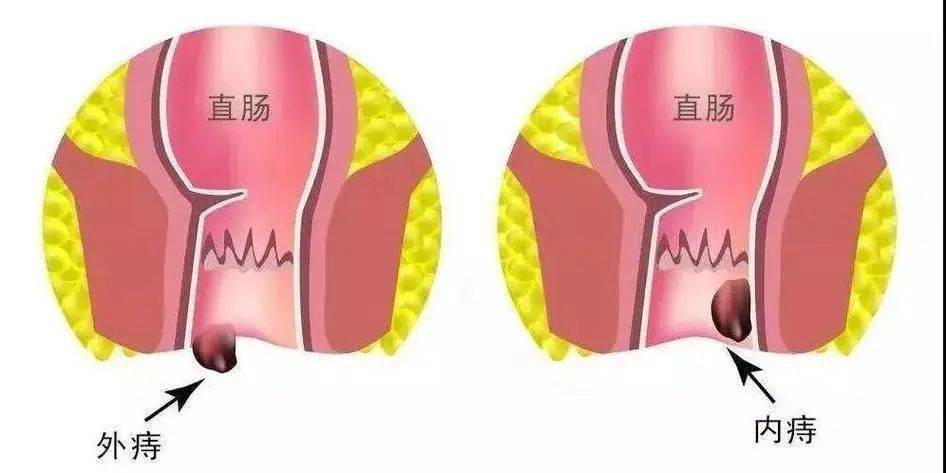 套扎痔核脱落图片图片