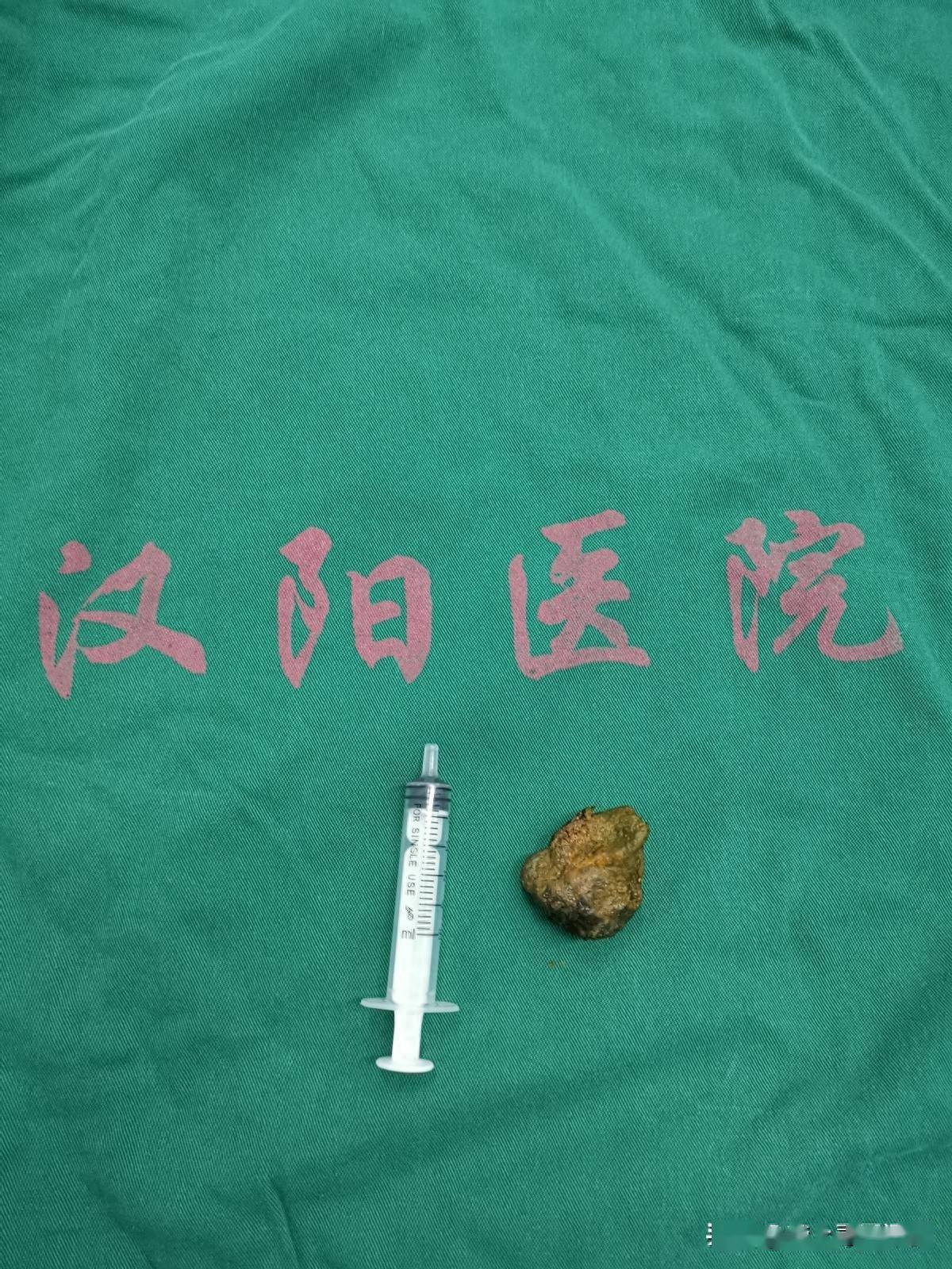 粪石性肠梗阻图片