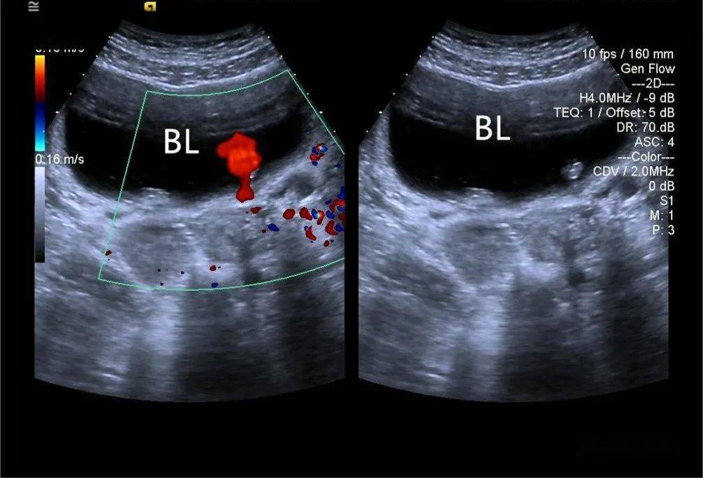 膀胱三角区超声图图片