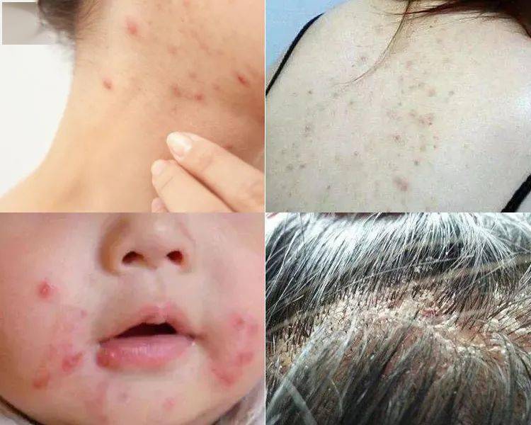 尤其是人类幼崽更是螨虫骚扰的对象.