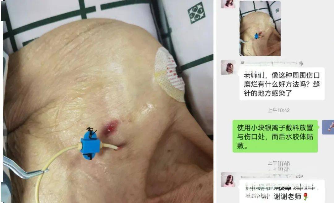 "使用小块阴离子敷料放置在伤口处,而后使用水胶体辅料覆盖,隔2--3天