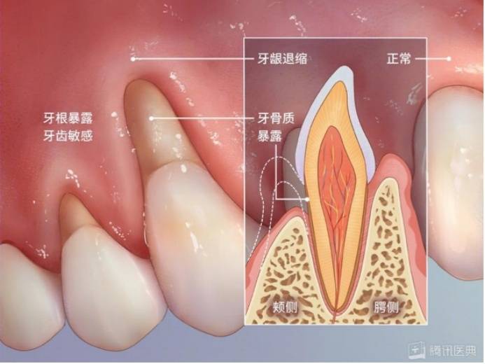 牙床露出白色骨头图片