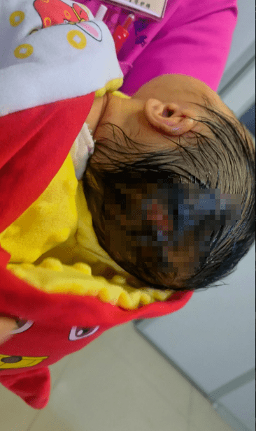 出生4天新生儿被护士烫伤头部,被烫伤的那一块没有头发