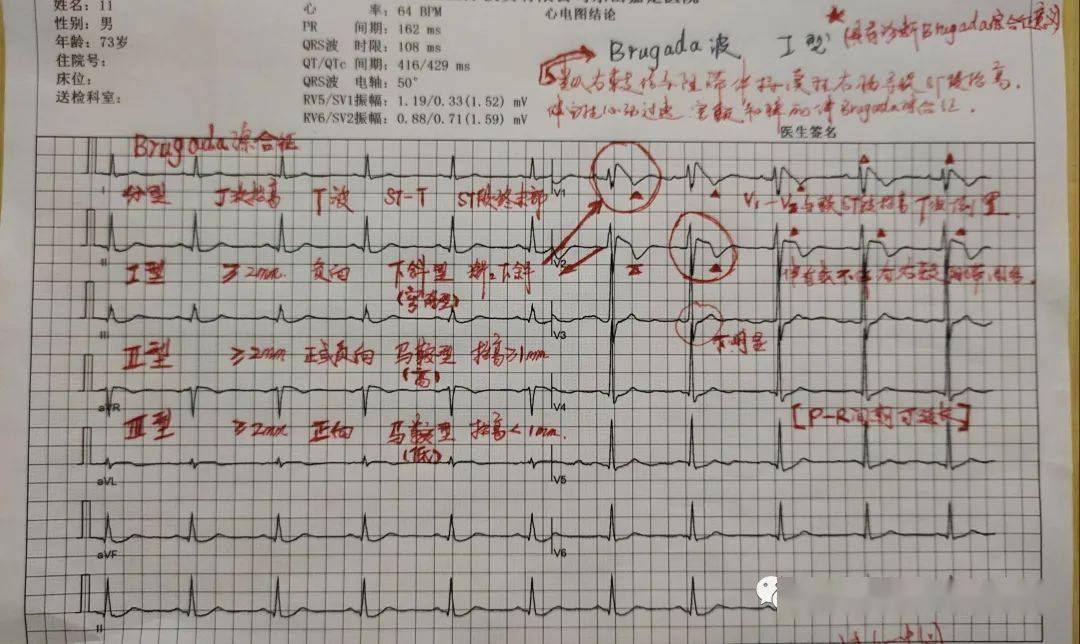 brugada波心电图意义图片
