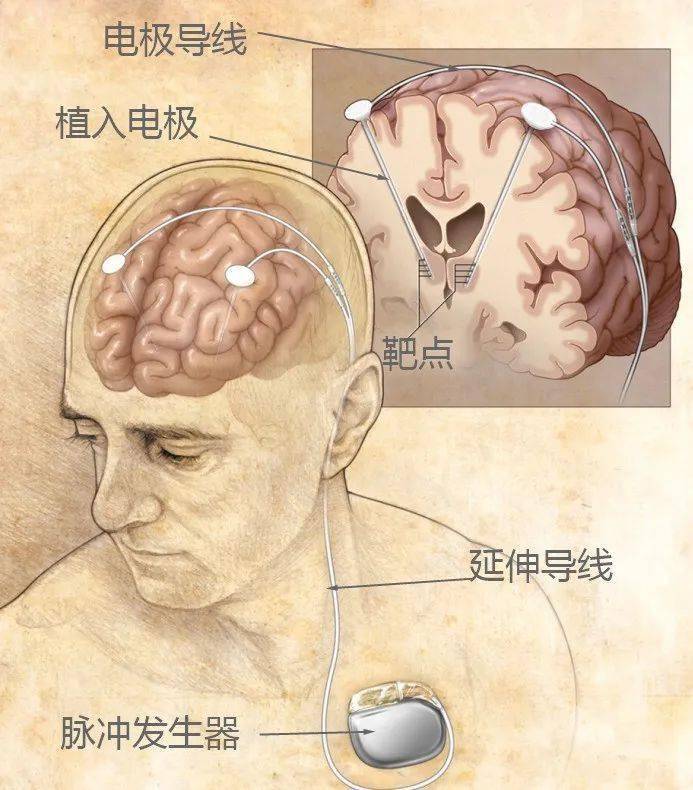 技术突破 | 聊城市二院成功开展医院首例脑起搏器植入术(dbs)_治疗